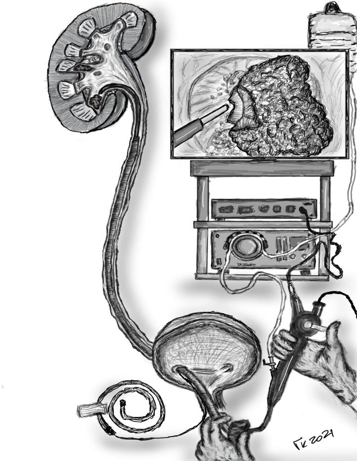 image10 Ureterorenoskopija - Dr Zejnilović, Dnevna bolnica i Laboratorija